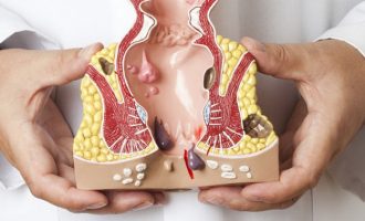 Лечение геморроя