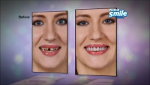 Что представляют собой Perfect Smile Veneers?